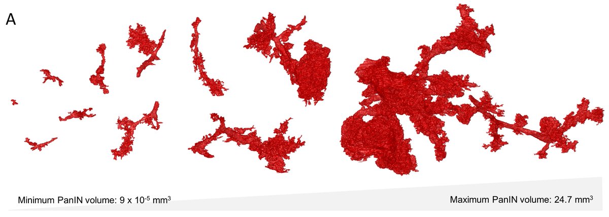 Ashley Kiemen (@ashleykiemen) on Twitter photo Sharing this cool collaboration with <a href="/ZwickerGroup/">Zwicker Group</a> out today in <a href="/ScienceAdvances/">Science Advances</a>! Using the 3D spatial information of >1,000 precancers from 48 human pancreas samples, we developed a mathematical growth model for pancreatic precancer growth: science.org/doi/10.1126/sc… Sharing this cool collaboration with <a href="/ZwickerGroup/">Zwicker Group</a> out today in <a href="/ScienceAdvances/">Science Advances</a>! Using the 3D spatial information of >1,000 precancers from 48 human pancreas samples, we developed a mathematical growth model for pancreatic precancer growth: science.org/doi/10.1126/sc…
