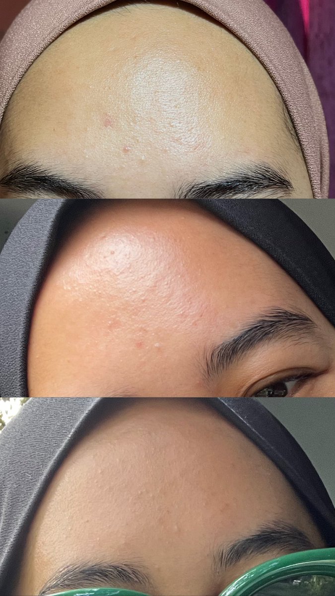 I selalu ada tiny bumps n redness kat dahi, tapi serum ni sangat helpful untuk reduce kan both of that problems. Macam tak percaya sebab dah la murah?? 

This brand is so underrated!