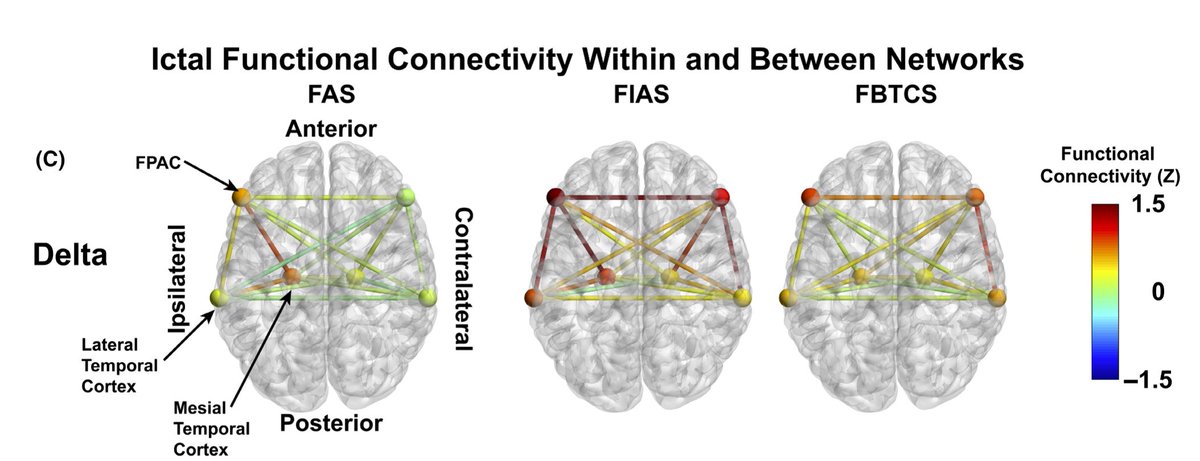 Dario J. Englot (@englot) on Twitter photo What are the network signatures of loss of consciousness during seizures? How do they relate to wakefulness and sleep networks?
New SEEG study in <a href="/EpilepsiaJourn/">Epilepsia</a> from #BIENlab <a href="/VanderbiltMSTP/">Vanderbilt MSTP</a> student <a href="/DerekDoss/">Derek Doss</a> and others
<a href="/VandyBME/">Vanderbilt BME</a> <a href="/VUMC_Neurosurg/">VUMC Neurosurgery</a>
onlinelibrary.wiley.com/doi/10.1111/ep… What are the network signatures of loss of consciousness during seizures? How do they relate to wakefulness and sleep networks?
New SEEG study in <a href="/EpilepsiaJourn/">Epilepsia</a> from #BIENlab <a href="/VanderbiltMSTP/">Vanderbilt MSTP</a> student <a href="/DerekDoss/">Derek Doss</a> and others
<a href="/VandyBME/">Vanderbilt BME</a> <a href="/VUMC_Neurosurg/">VUMC Neurosurgery</a>
onlinelibrary.wiley.com/doi/10.1111/ep…