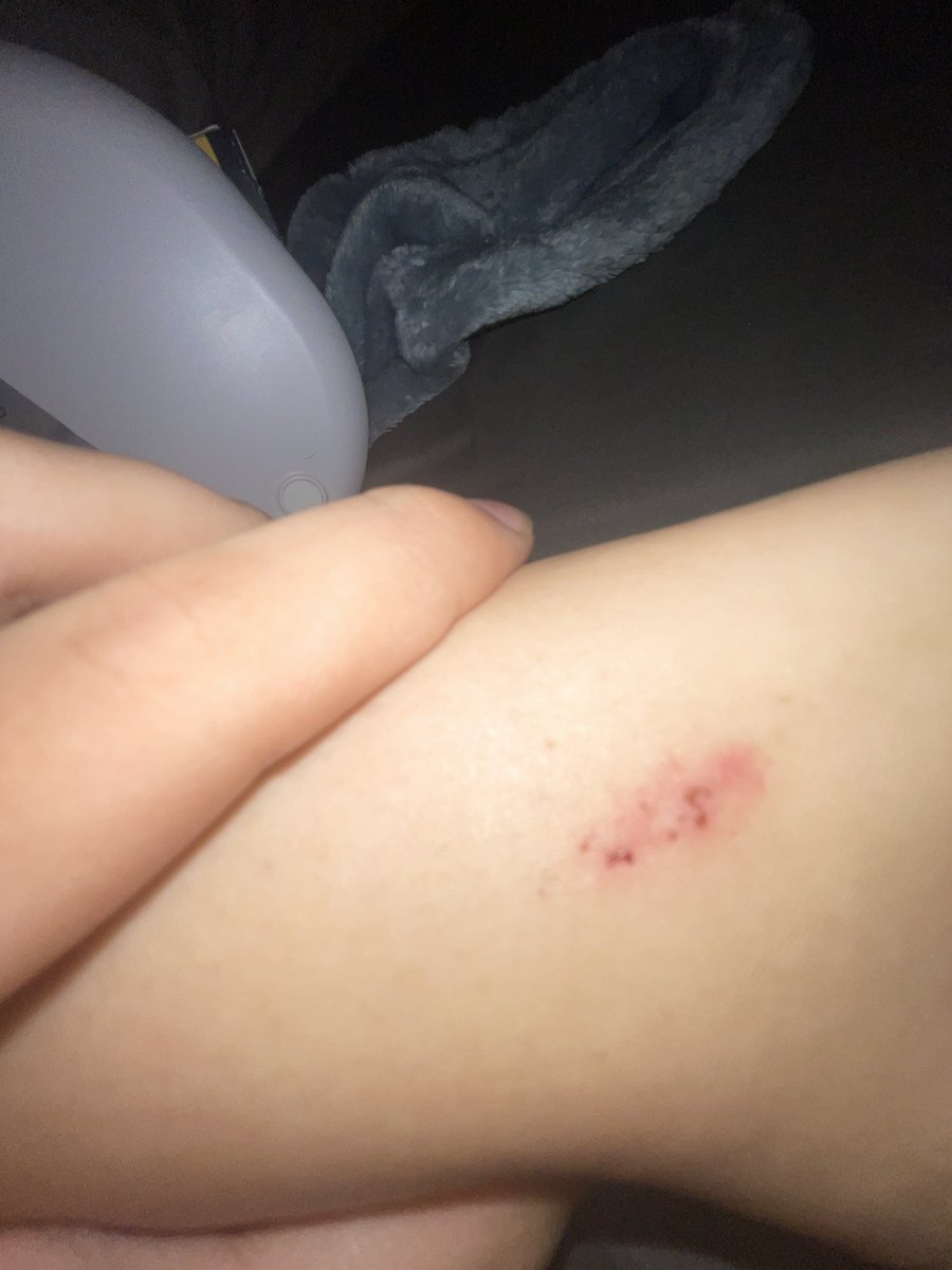 jiraislut's tweet photo. ouch i hate bugs https://t.co/iLd23lPtPL