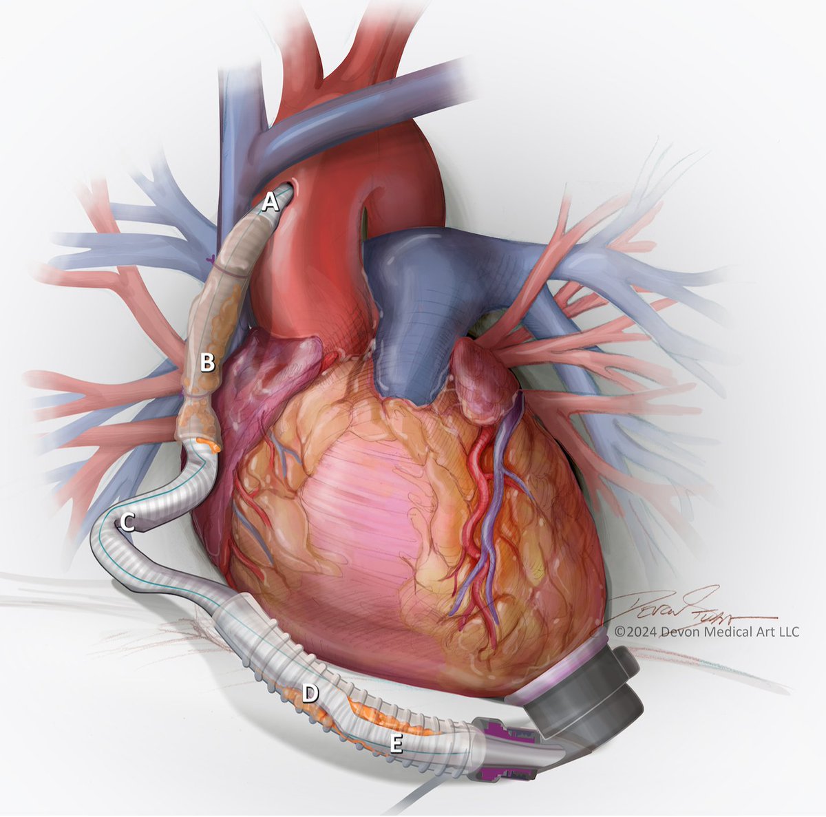 Manreet Kanwar (@manreetkanwar) on Twitter photo HeartMate3 EOGO : A State-of-the-Art Review for diagnosis and management @JHLT <a href="/preventfailure/">Jennifer Cowger</a> <a href="/JeffTeuteberg/">Jeff Teuteberg</a> <a href="/JosefStehlik/">Josef Stehlik</a> jhltonline.org/article/S1053-โฆ <a href="/RyanTedfordMD/">Ryan J Tedford MD</a> <a href="/AndrewJSauer/">Andrew J Sauer MD</a> <a href="/NirUrielMD/">Nir Uriel, MD MSc</a> <a href="/MattLanderMD/">Matt Lander</a> <a href="/TomCascinoMD/">Tom Cascino, MD</a> <a href="/AditiNayakMD/">Aditi Nayak</a> <a href="/StavrosDrakos/">Stavros George Drakos</a> HeartMate3 EOGO : A State-of-the-Art Review for diagnosis and management @JHLT <a href="/preventfailure/">Jennifer Cowger</a> <a href="/JeffTeuteberg/">Jeff Teuteberg</a> <a href="/JosefStehlik/">Josef Stehlik</a> jhltonline.org/article/S1053-โฆ <a href="/RyanTedfordMD/">Ryan J Tedford MD</a> <a href="/AndrewJSauer/">Andrew J Sauer MD</a> <a href="/NirUrielMD/">Nir Uriel, MD MSc</a> <a href="/MattLanderMD/">Matt Lander</a> <a href="/TomCascinoMD/">Tom Cascino, MD</a> <a href="/AditiNayakMD/">Aditi Nayak</a> <a href="/StavrosDrakos/">Stavros George Drakos</a>