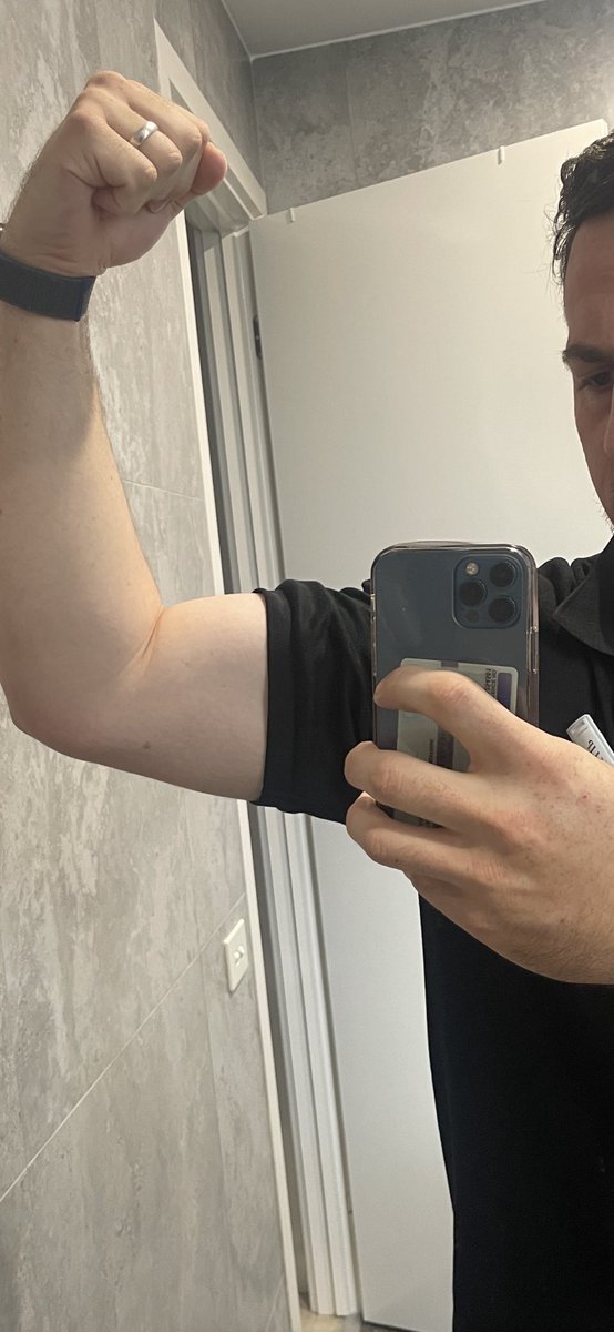 phill_hibbert's tweet image. Looking to grow my huge biceps quickly - synthol, silicone or steroids, can anyone help me?

#siliconebulge #synthol #biceps #siliconebiceps #injection #syntholbiceps #steriods