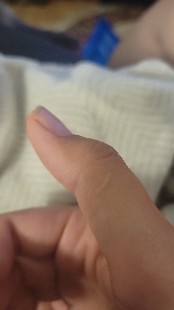 eelnosidam's tweet photo. @cinnotomon Sliced my thumb with the edge of a pull tab ravioli can lid, created a gill at the time https://t.co/c3TFoFzDPw