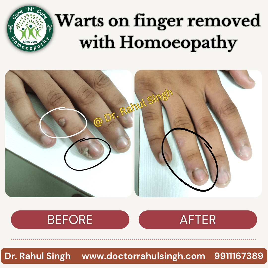 singh_rahul29's tweet photo. 🌿 Say goodbye to warts naturally! 🌿

#Homeopathy #NaturalHealing #Warts #ClearSkin #BeforeAndAfter #drrahulsingh #drsinghhomeopath #homoeopathyworks https://t.co/kk1iaE9yYQ
