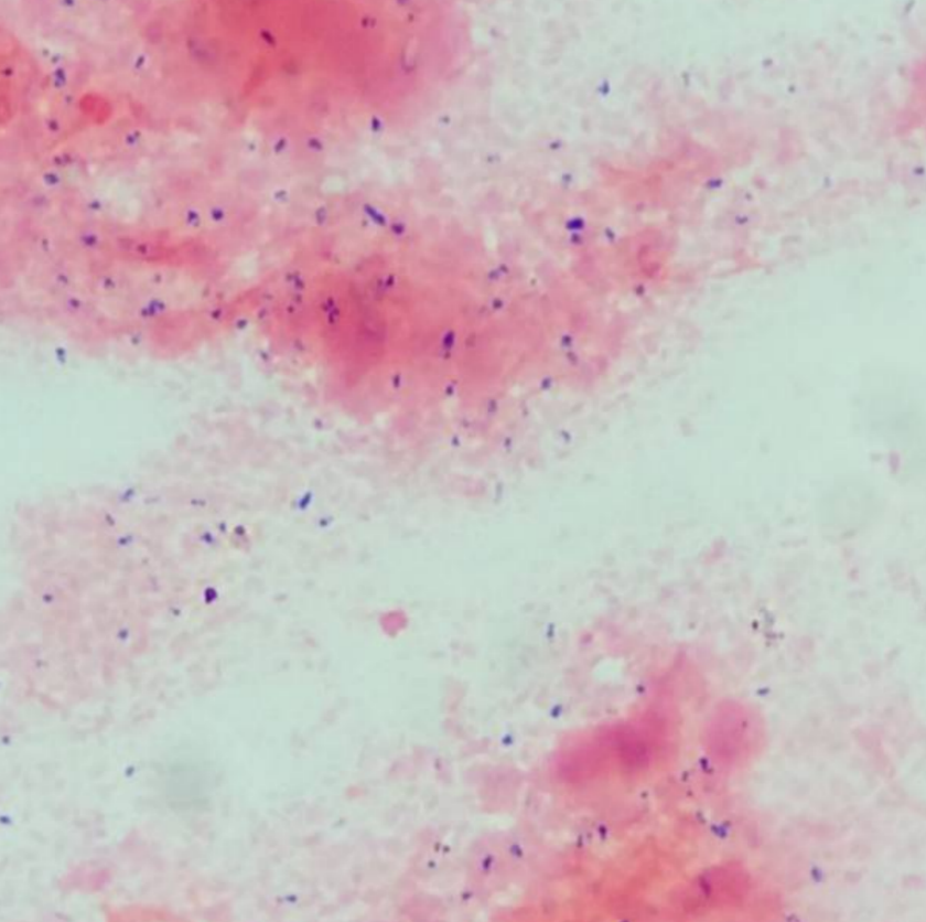 Thidathipw's tweet photo. It's Saturday, however, patients are still waiting for treatment. The doctor is eager to know the results. The doctor's questions are:
1. What is the bacterium?
2. What antibiotics is it resistant to?
3. How many species of bacteria are there? Mixed infection? @nanopore https://t.co/Ry6mi5r3dZ