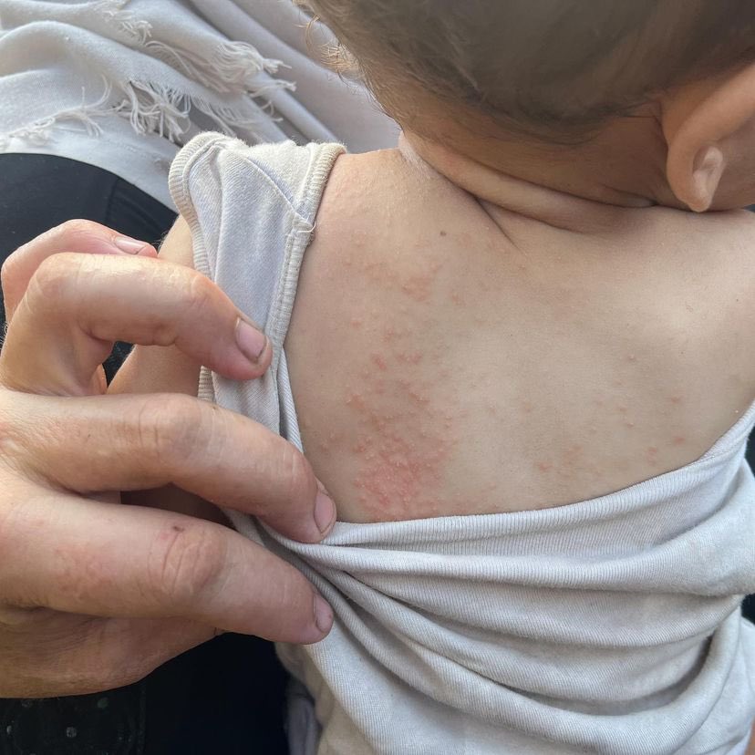 EyeonPalestine's tweet photo. The spread of skin diseases
among children in displacement camps due to the lack of hygiene tools and water. https://t.co/4X2ehp2qvj