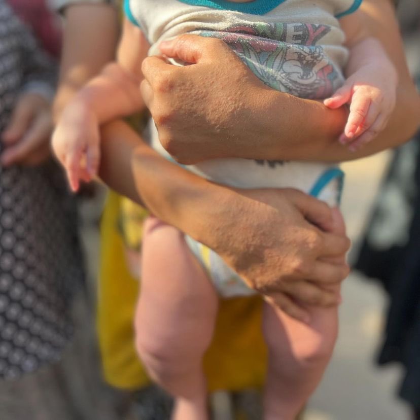 EyeonPalestine's tweet photo. The spread of skin diseases
among children in displacement camps due to the lack of hygiene tools and water. https://t.co/4X2ehp2qvj