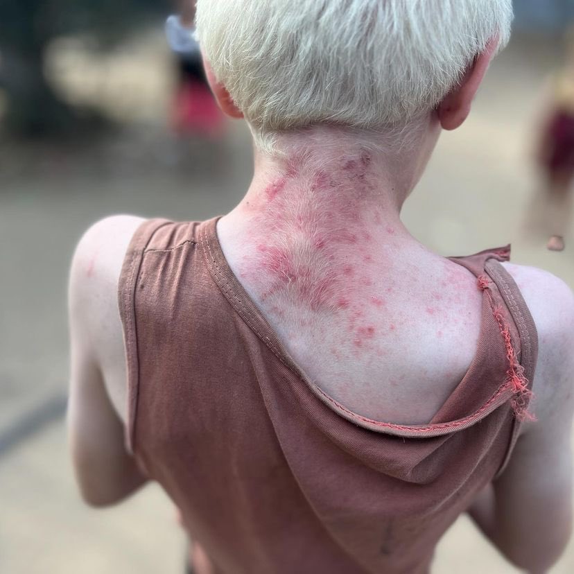 EyeonPalestine's tweet photo. The spread of skin diseases
among children in displacement camps due to the lack of hygiene tools and water. https://t.co/4X2ehp2qvj