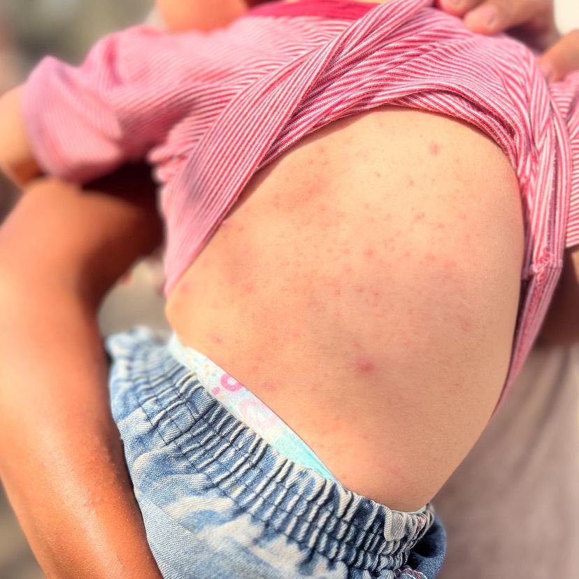 EyeonPalestine's tweet photo. The spread of skin diseases
among children in displacement camps due to the lack of hygiene tools and water. https://t.co/4X2ehp2qvj