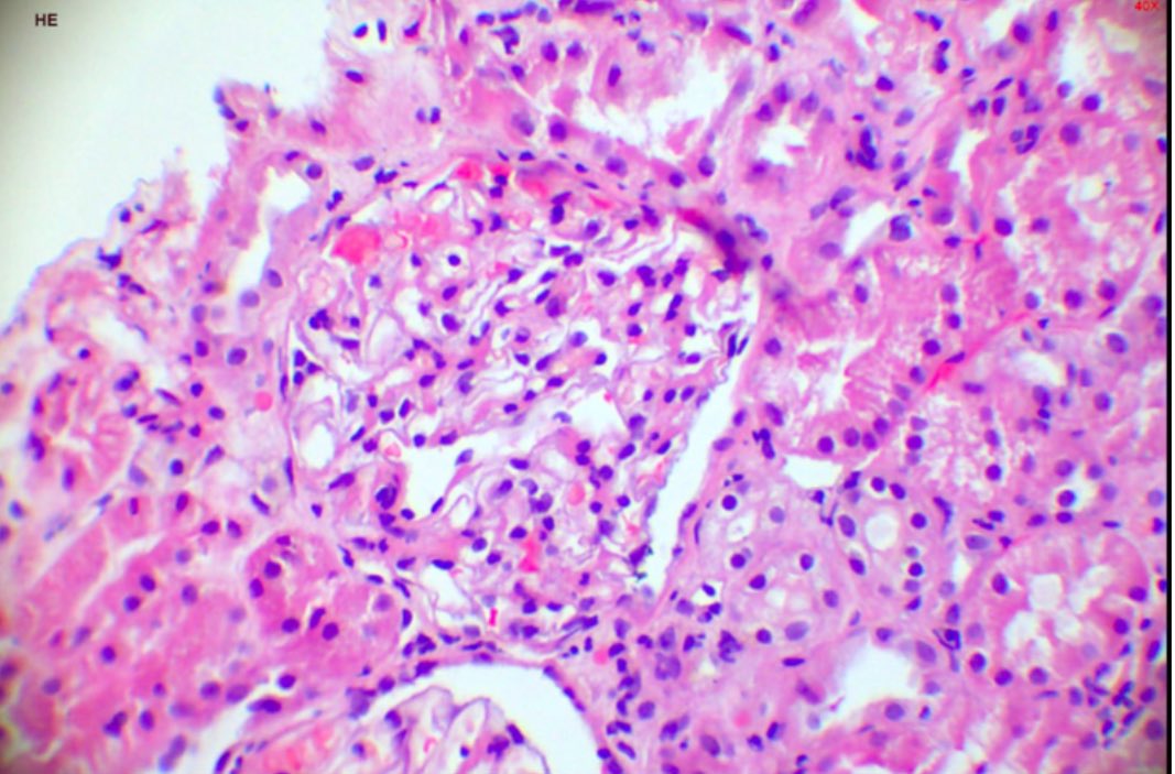 saurabhmukewar's tweet image. EUS guided Kidney Biopsy. Expanding the role of EUS..