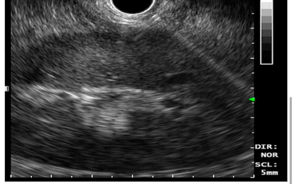 saurabhmukewar's tweet image. EUS guided Kidney Biopsy. Expanding the role of EUS..