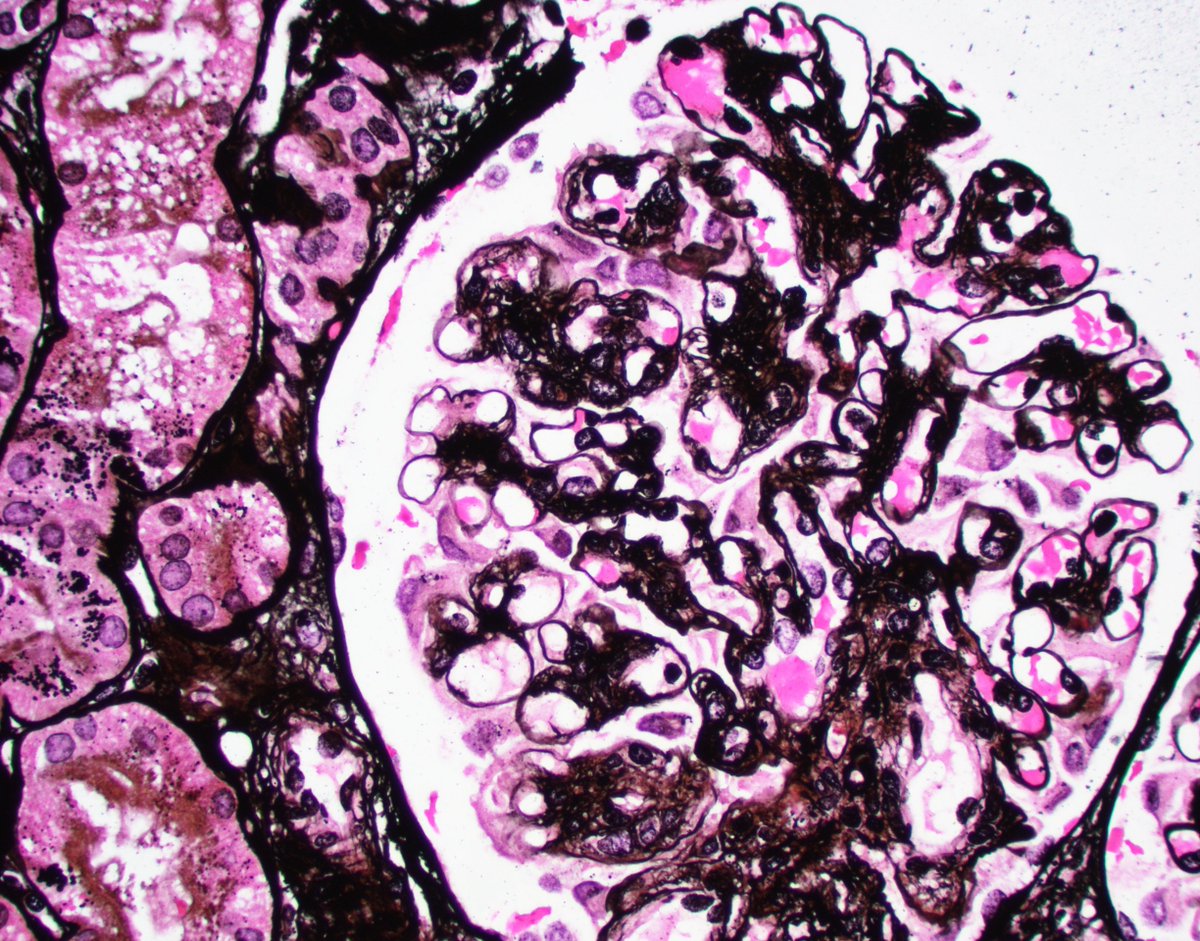 JZRenalPath's tweet image. Biopsy for CKD and proteinuria. +cryocrit and low C4. IgM dominant GN with MPGN pattern and short microtubules in EM c/w a low grade cyro GN. Organized deposits may be rare and ill formed in cryo GN. EM below is about the best one usually gets. #renalpath #pathtwitter #nephrology