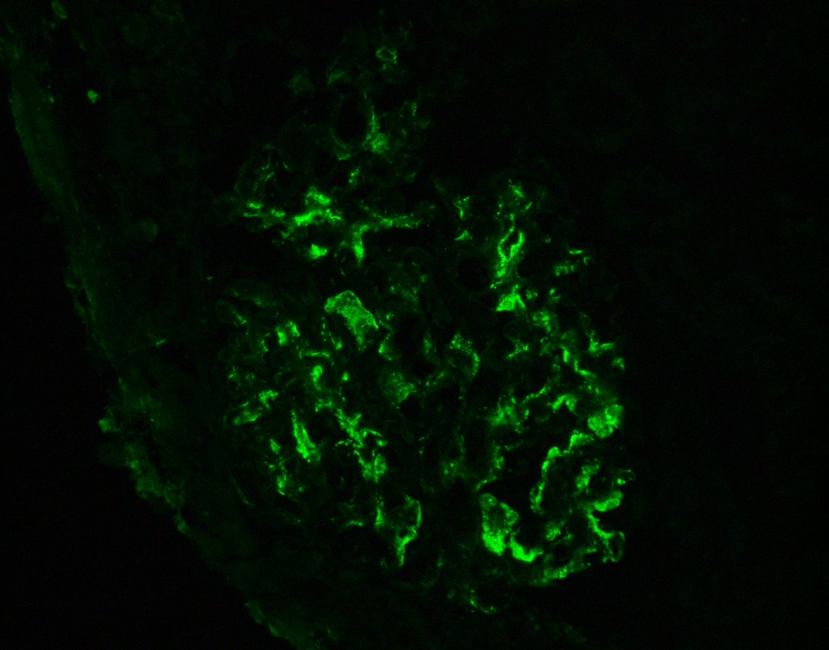 JZRenalPath's tweet image. Biopsy for CKD and proteinuria. +cryocrit and low C4. IgM dominant GN with MPGN pattern and short microtubules in EM c/w a low grade cyro GN. Organized deposits may be rare and ill formed in cryo GN. EM below is about the best one usually gets. #renalpath #pathtwitter #nephrology