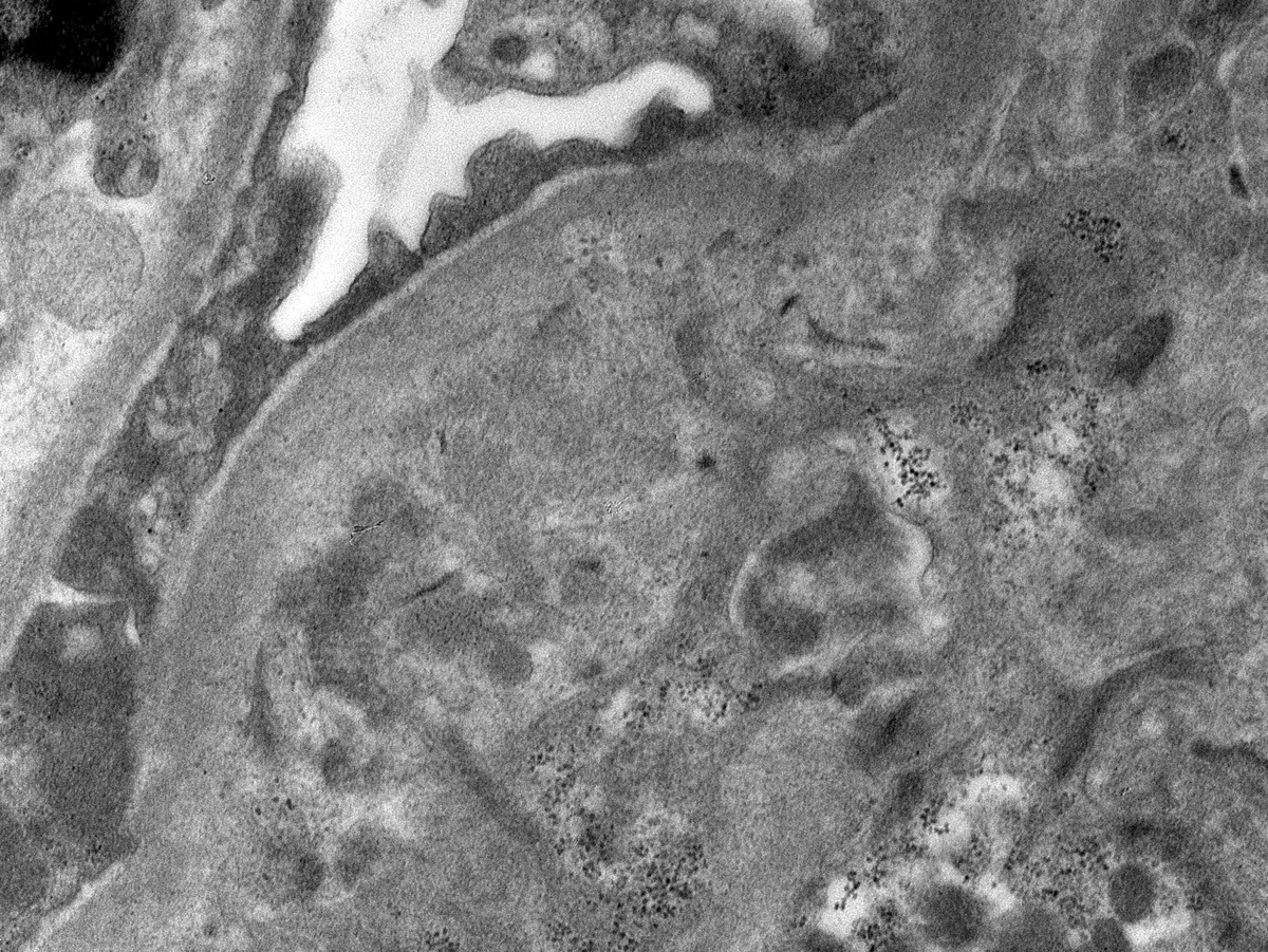 JZRenalPath's tweet image. Biopsy for CKD and proteinuria. +cryocrit and low C4. IgM dominant GN with MPGN pattern and short microtubules in EM c/w a low grade cyro GN. Organized deposits may be rare and ill formed in cryo GN. EM below is about the best one usually gets. #renalpath #pathtwitter #nephrology