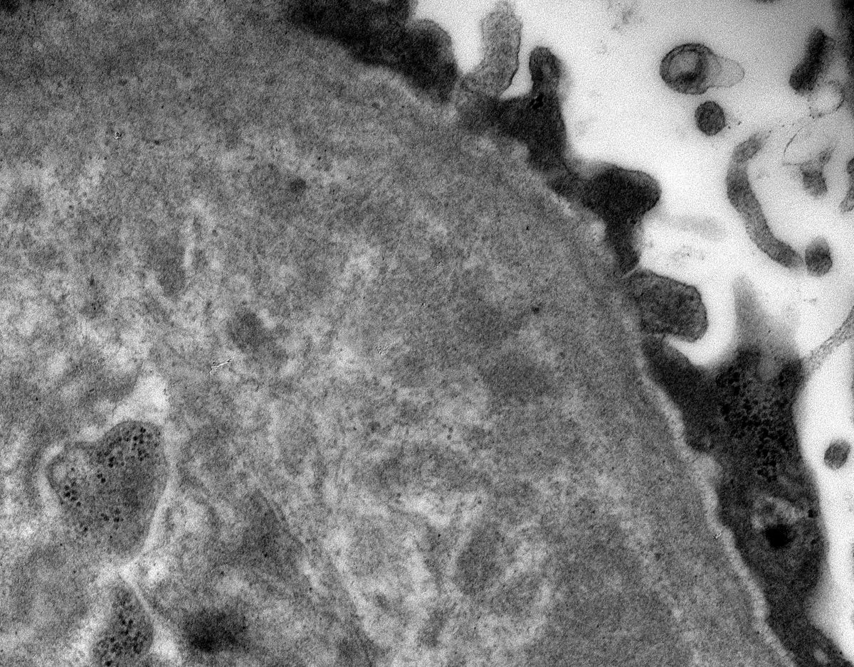 JZRenalPath's tweet image. Biopsy for CKD and proteinuria. +cryocrit and low C4. IgM dominant GN with MPGN pattern and short microtubules in EM c/w a low grade cyro GN. Organized deposits may be rare and ill formed in cryo GN. EM below is about the best one usually gets. #renalpath #pathtwitter #nephrology