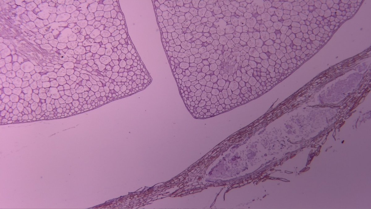 MAHoureih's tweet image. 1/3 #GIpath elderly. Sent as "? calculous" found between first and second portion of duodenum. @Histopatolomon @smlungpathguy @yro854 @RunjanChetty @Mvgs1706 @DrMarkOng @DrGeeONE @ariella8 @DanGrahamMD @DrRanasaleh @xenaalabbas @kis_lorand @glinglerimek @Dina_hussein94
