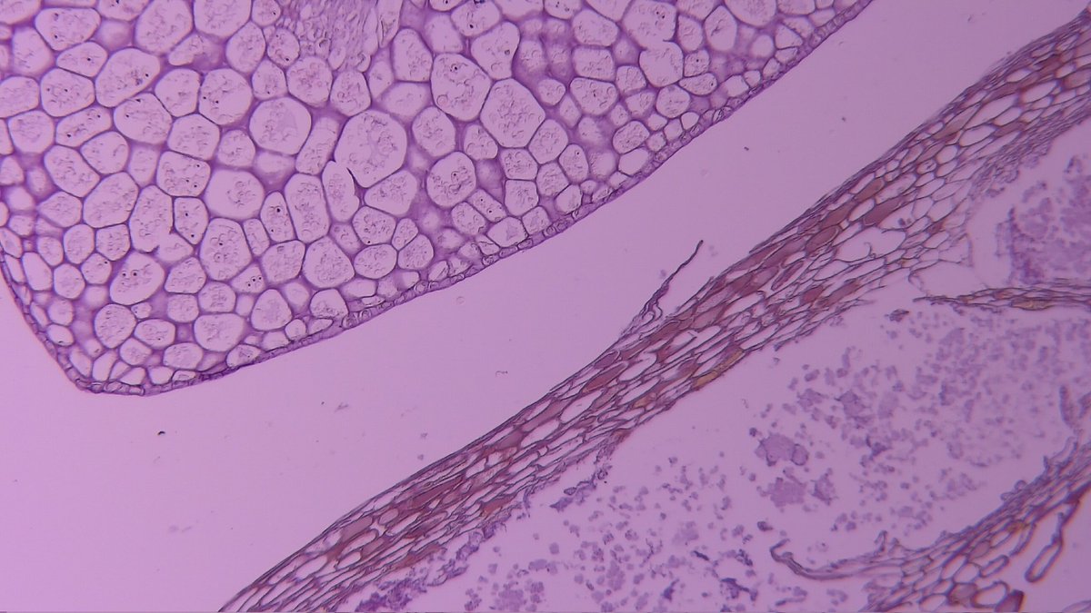 MAHoureih's tweet image. 1/3 #GIpath elderly. Sent as "? calculous" found between first and second portion of duodenum. @Histopatolomon @smlungpathguy @yro854 @RunjanChetty @Mvgs1706 @DrMarkOng @DrGeeONE @ariella8 @DanGrahamMD @DrRanasaleh @xenaalabbas @kis_lorand @glinglerimek @Dina_hussein94