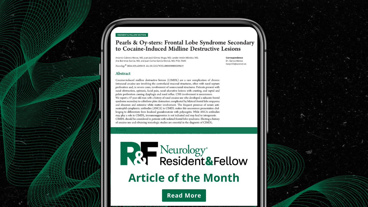 Each month, the #NeurologyRF editorial board selects their favorite article for the month. Read their current pick, "Pearls &amp; Oy-sters: Frontal Lobe Syndrome Secondary to Cocaine-Induced Midline Destructive Lesions": bit.ly/4bnkHxB