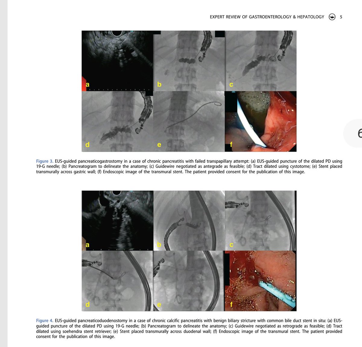 Happy to share our new review article in "Expert Review of Gastroenterology and Hepatology" <a href="/tandfonline/">Taylor & Francis Research Insights</a> 😊

"Endoscopic ultrasound-guided pancreatic duct drainage: a comprehensive state of the art review"

Sincere thanks 🙏to <a href="/Samanta_JayPGI/">Samanta Jayanta</a> for leading it beautifully...🇮🇳
