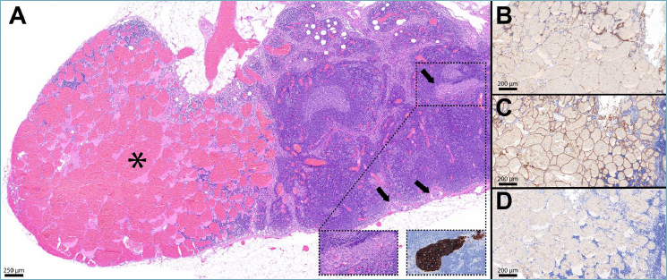 Pathologica (@ita_path) on Twitter photo Latest in #Pathologica: "Concurrent presence of primary hemangioma and #breastcancer metastasis within a lymph node: a case report inspired by the legacy of Professor Juan Rosai" by <a href="/FabioPagni1/">fabio.pagni@unimib.it</a> @NicolaFuscoMD et al
pathologica.it/article/view/9…
#PathX #PathResidents Latest in #Pathologica: "Concurrent presence of primary hemangioma and #breastcancer metastasis within a lymph node: a case report inspired by the legacy of Professor Juan Rosai" by <a href="/FabioPagni1/">fabio.pagni@unimib.it</a> @NicolaFuscoMD et al
pathologica.it/article/view/9…
#PathX #PathResidents