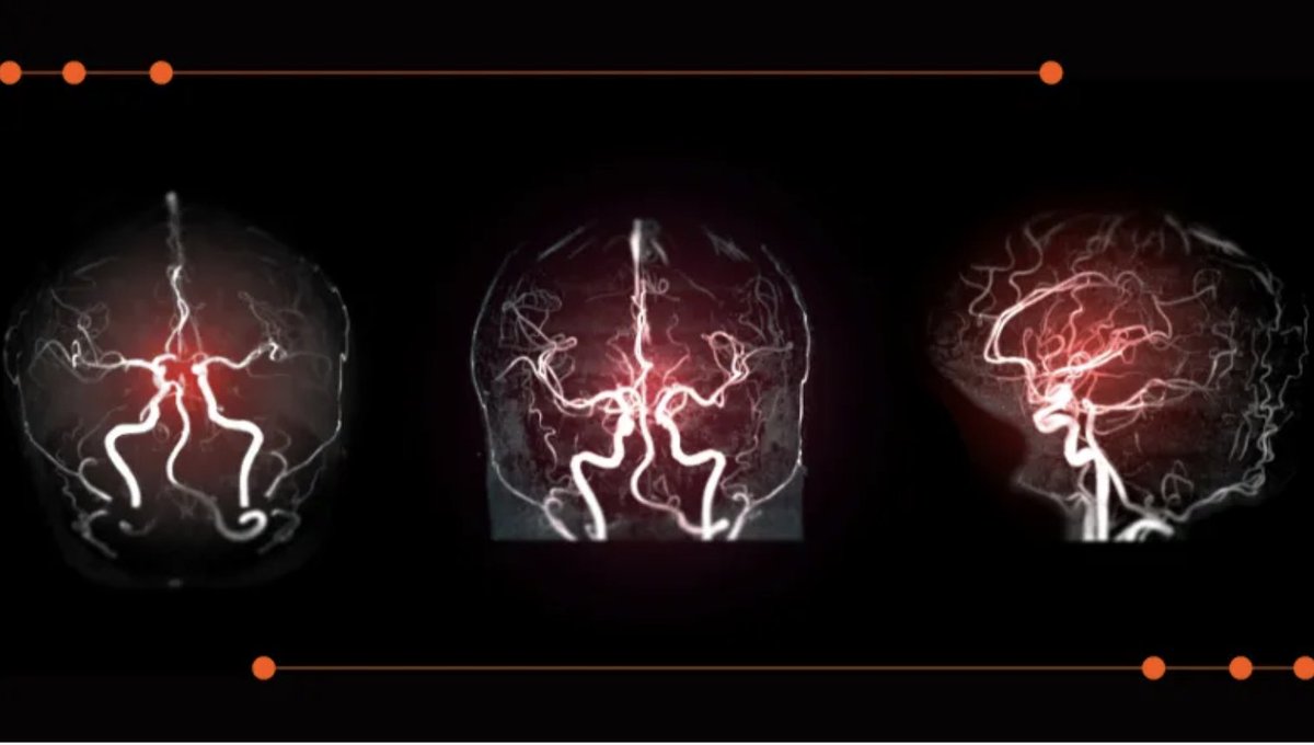 linkedin.com/feed/update/ur…
We can navigate unseen patient blood vessels moving us closer to realising the full benefits of robotic clot removal with autonomous assistance - great teamwork with Harry leading on this world-leading research