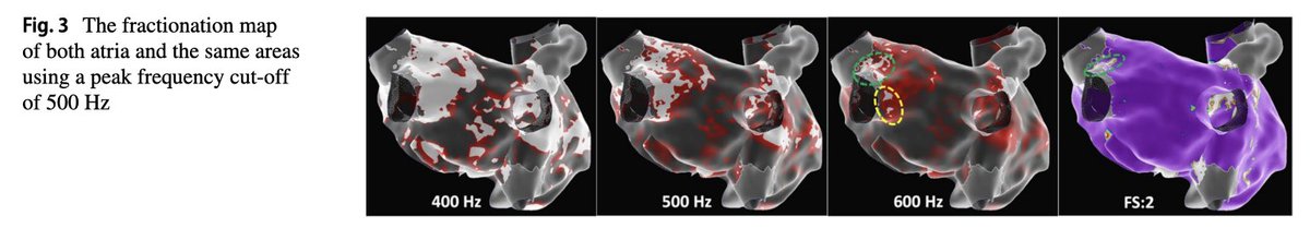 Timothy Markman (@dr_markman) on Twitter photo Great work describing this approach by <a href="/MDTolgaAksu/">Tolga Aksu, MD</a> <a href="/hhuang123/">Henry D. Huang</a>! We have been impressed by peak frequency for #CNA <a href="/PennEPFellows/">Penn Electrophysiology Fellowship</a>. When combined w/ fractionation & other GP mapping tools, getting closer to a standardized approach for #EPeeps performing CNA
rdcu.be/dOXrH Great work describing this approach by <a href="/MDTolgaAksu/">Tolga Aksu, MD</a> <a href="/hhuang123/">Henry D. Huang</a>! We have been impressed by peak frequency for #CNA <a href="/PennEPFellows/">Penn Electrophysiology Fellowship</a>. When combined w/ fractionation & other GP mapping tools, getting closer to a standardized approach for #EPeeps performing CNA
rdcu.be/dOXrH
