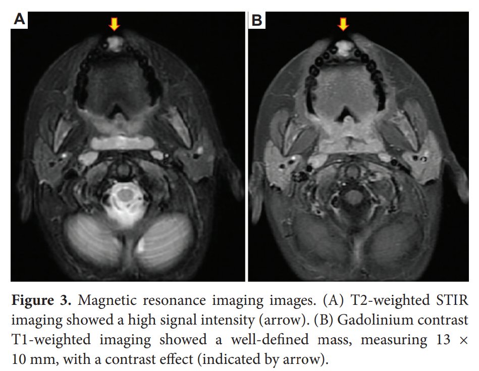 🧐We welcome you to read "Pyogenic #granuloma of maxillary median #gingiva in a pediatric patient: A case report and literature review" 
By Takeshi Karube et al.
Full text: doi.org/10.36922/td.22…
