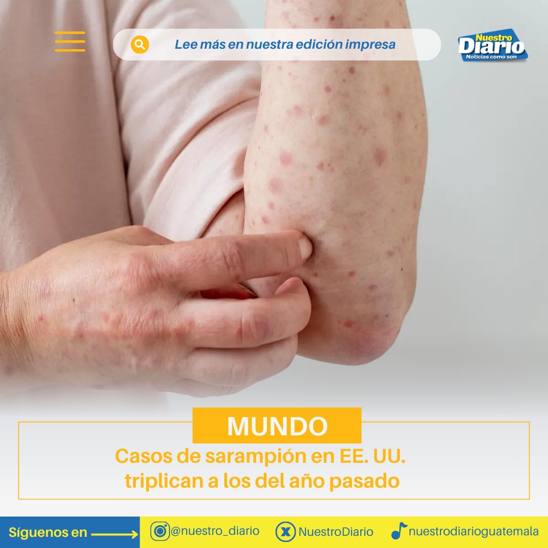 NuestroDiario's tweet photo. PREOCUPANTES CIFRAS🇺🇸
#MUNDO | Los Centros para el Control y Prevención de Enfermedades alertaron que el número de casos de sarampión en Estados Unidos han triplicado al total de 2023. Según autoridades, este año se han registrado 188 casos.
Conoce más en #NDPlay📱
📸: Archivo https://t.co/bIe73DgMQN