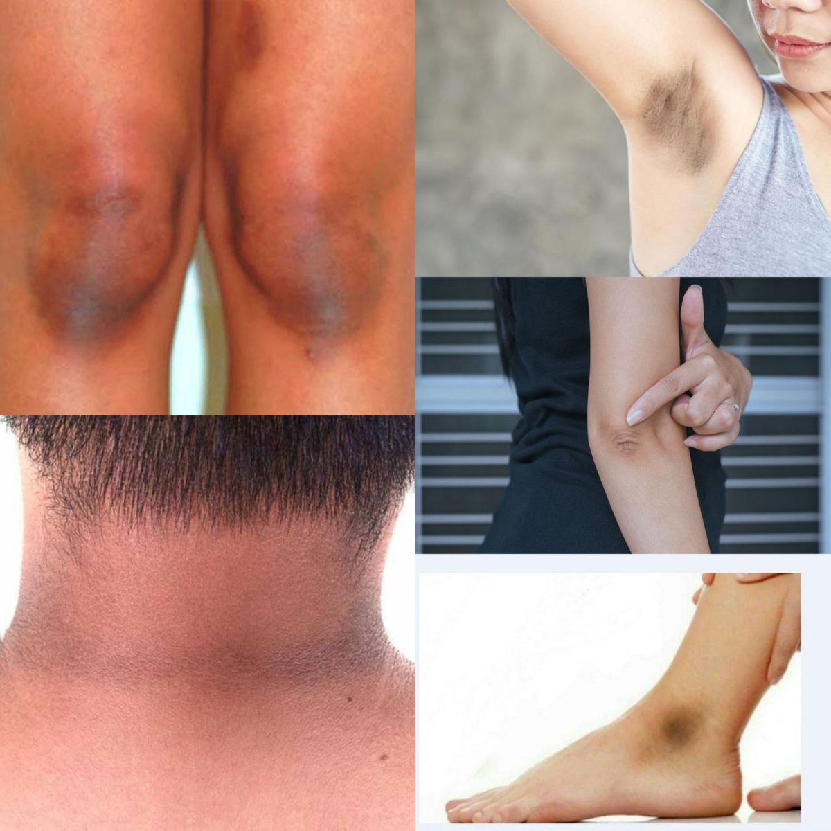 adelweisx's tweet image. Treatment Mencerahkan lipatan kulit gelap✨

-A Thread -