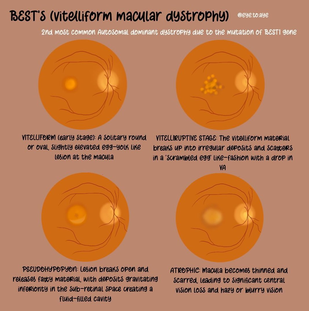 Opthalmologycas's tweet photo. Best's disease.
Image credit: eye to aye https://t.co/arKuZ3l2g7 https://t.co/P6LjDxtycQ