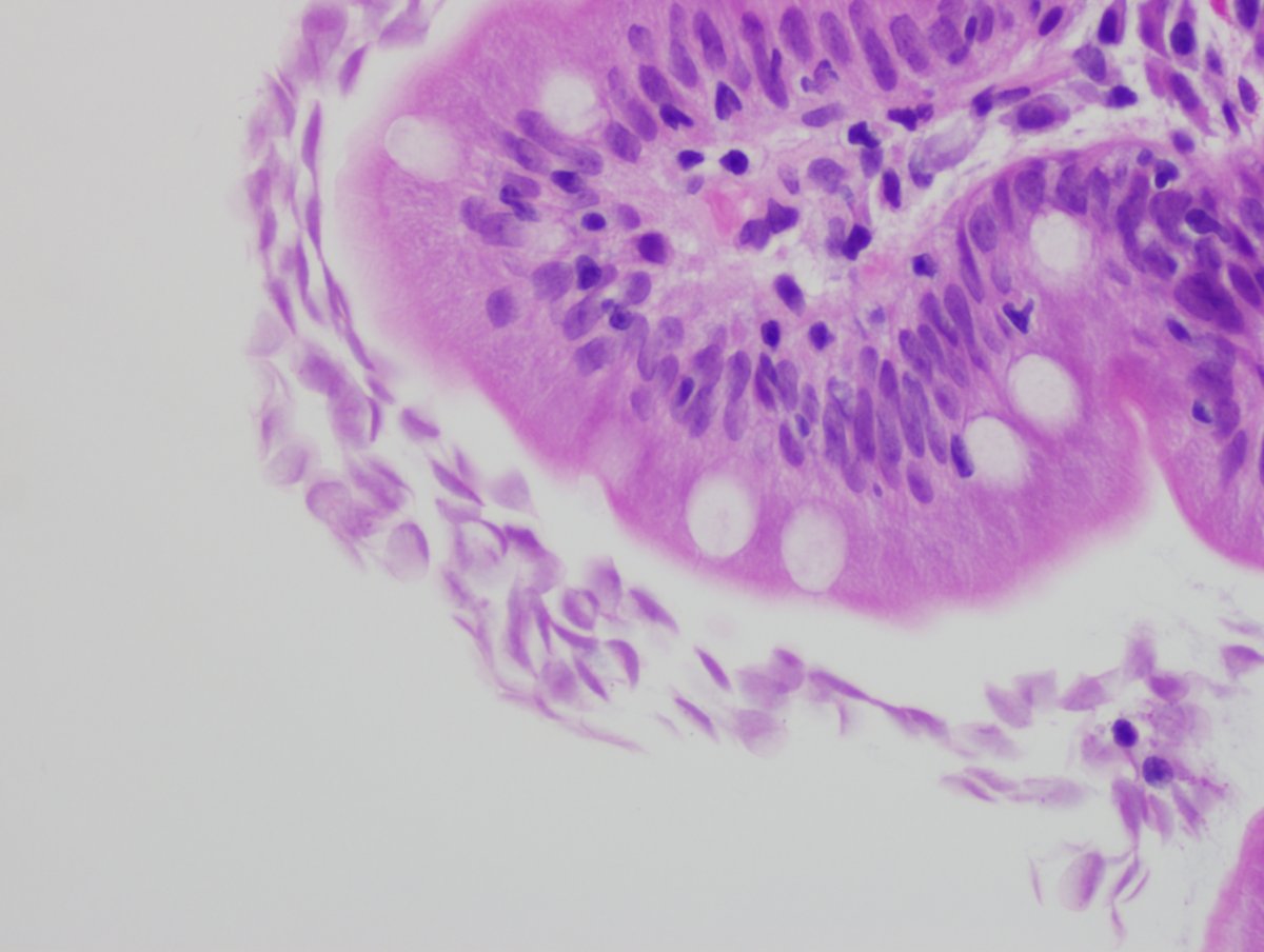 smlungpathguy's tweet image. Giardia in a duodenal biopsy. What is your favorite description of these critters? Pale butts? Falling leaves? 

#pathbugs #crittersontwitter