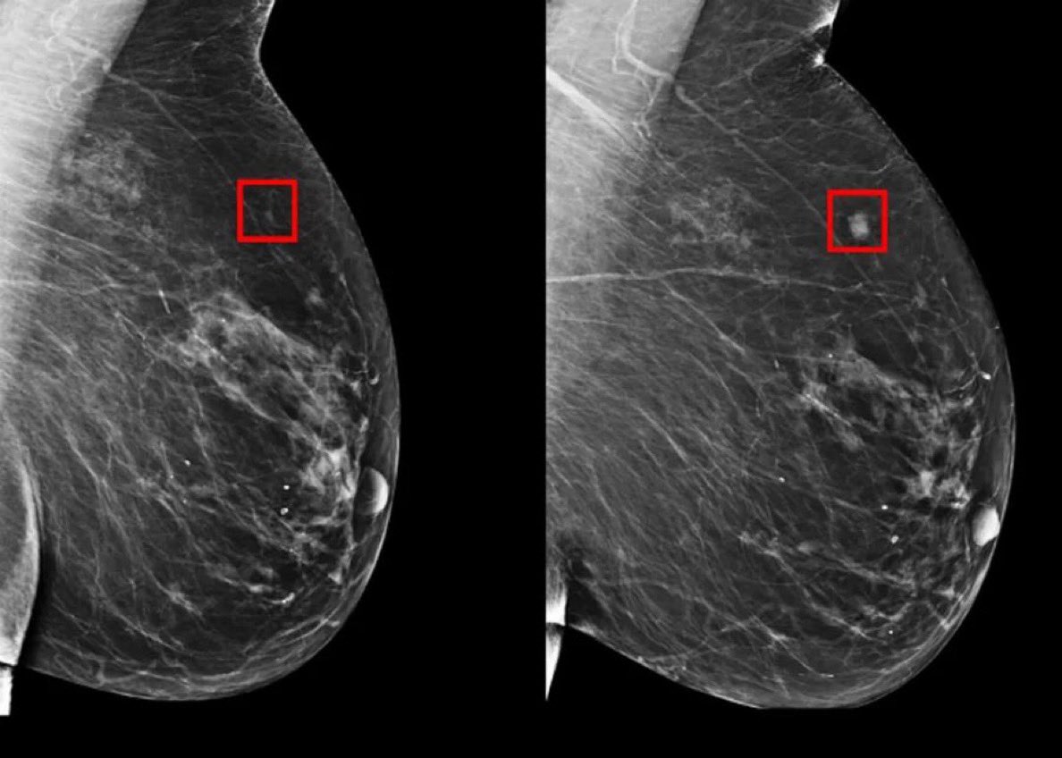 Asquaretechtalk's tweet photo. Artificial intelligence detects breast cancer 5 years before it develops

#MedEd #MedTwitter #SCIENCE #technology #oncology #Cancer
#Diagnosis https://t.co/GeCUI3iaBp