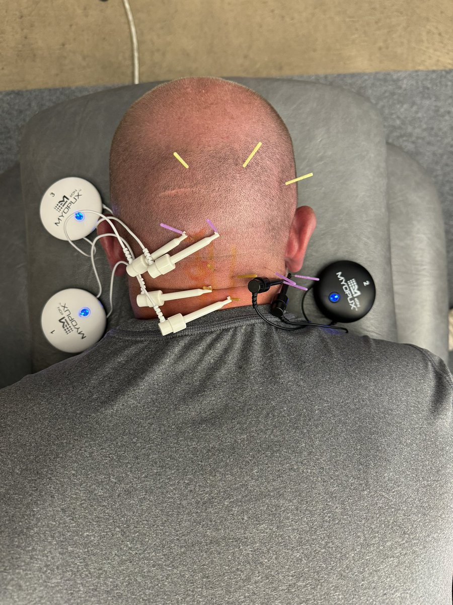 DN-1 Boulder is complete with 1 ATC, 3 DCs, and 14 PTs now ready to treat Thoracic, Cervical, Head/Jaw/Face, and Upper Extremity conditions! Mega thanks to PT of Boulder for hosting! #DryNeedling #AAMTfellowship