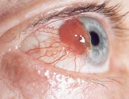 JofCancerPrev's tweet photo. Eye cancer includes several rare types of cancers that begin in eye, including  eyeball and the structures surrounding the eyeball. Eye cancer starts when cells multiply out of control and form a tumor. 
#eye #cancer #spread #malignant #eyeball #rare #noncancerous https://t.co/wgWqaPx5qg
