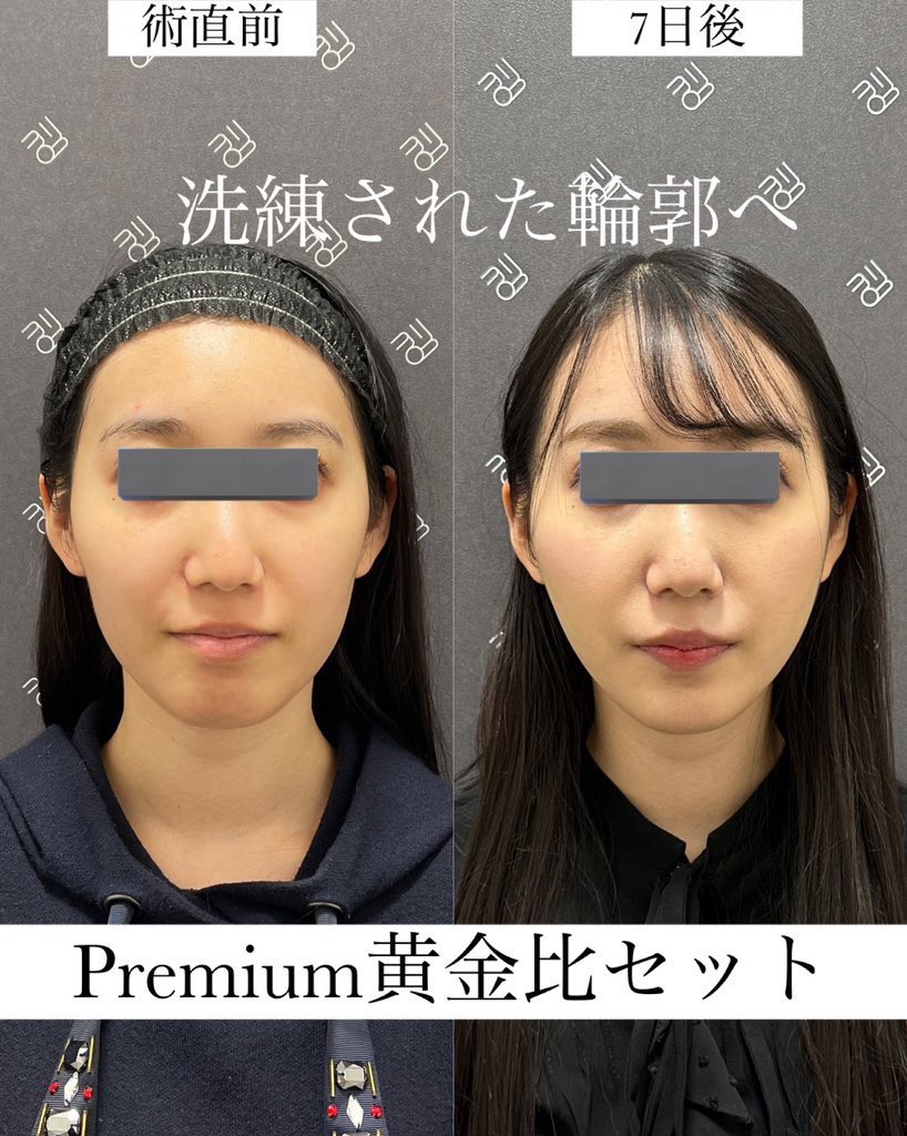 なおき先生👨‍⚕️クマ脂肪注入専門 tweet media