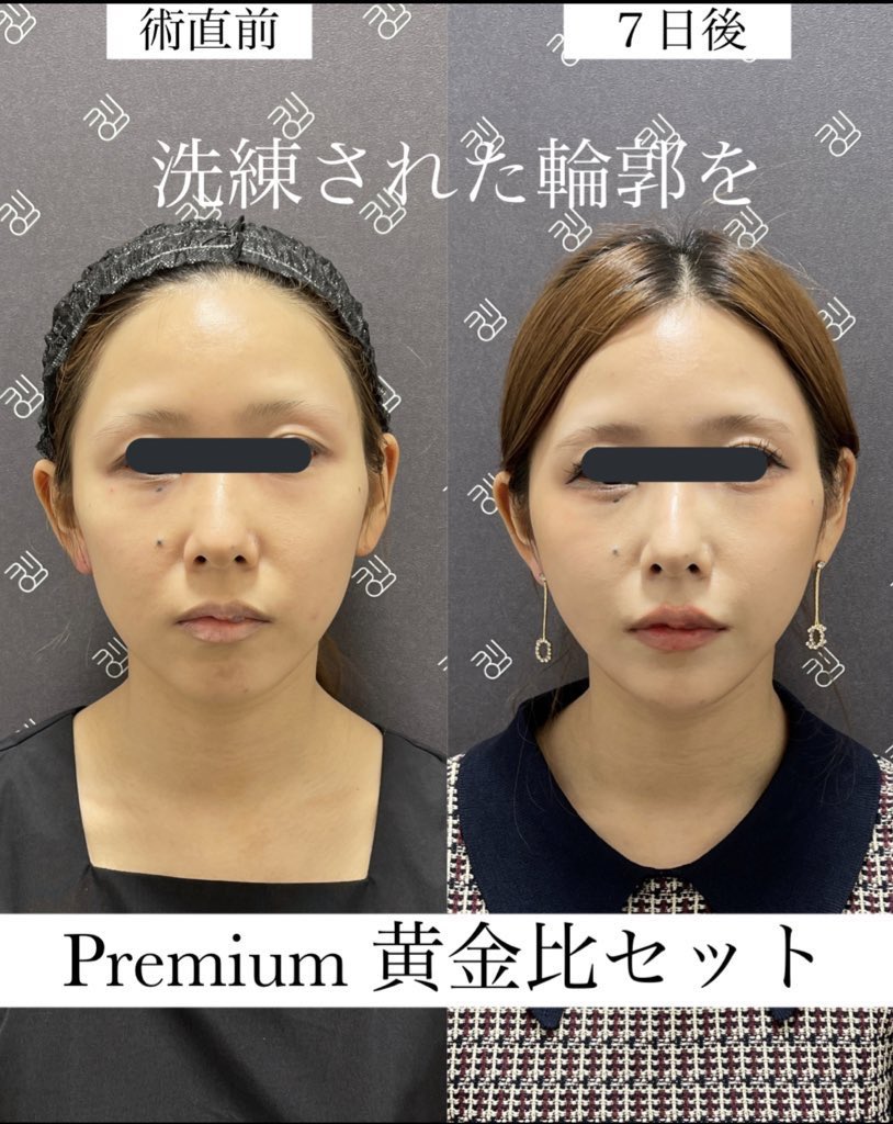 なおき先生👨‍⚕️クマ脂肪注入専門 tweet media