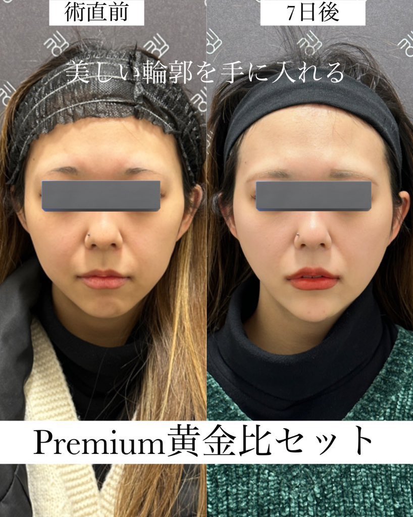 なおき先生👨‍⚕️クマ脂肪注入専門 tweet media