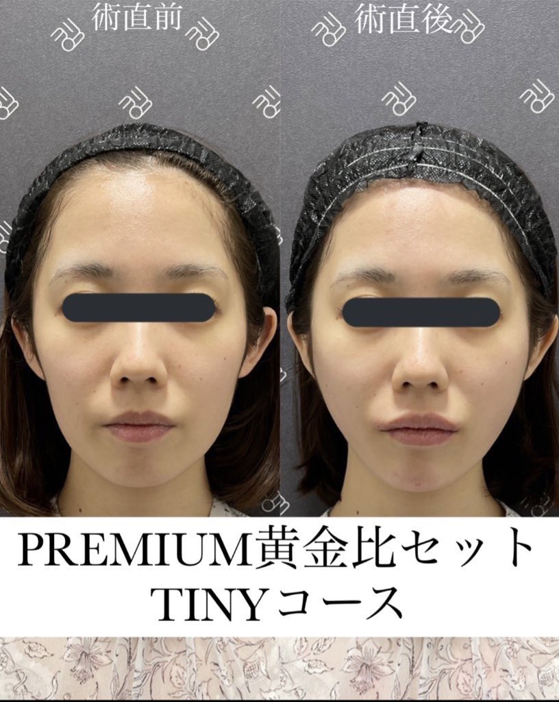 なおき先生👨‍⚕️クマ脂肪注入専門 tweet media