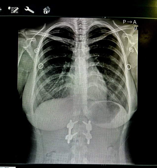 そういえば今日レントゲン撮った
背骨まっすくで嬉しい✨ 