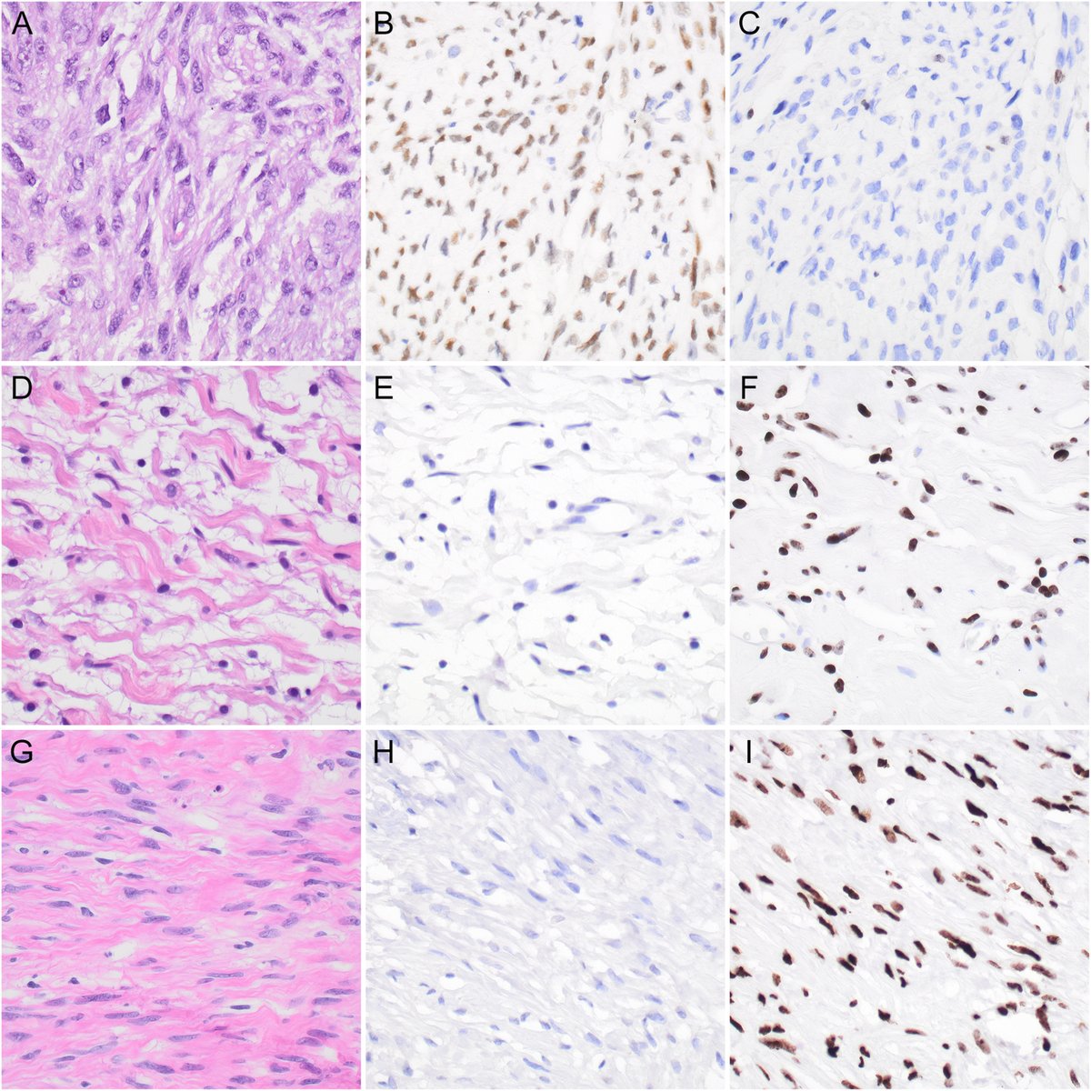 New in #HumPathol: TRPS1 expression in MPNST is correlated with PRC2 inactivation and loss of H2K27me3. sciencedirect.com/science/articl… #pathology #PathTwitter #PathX #BSTpath