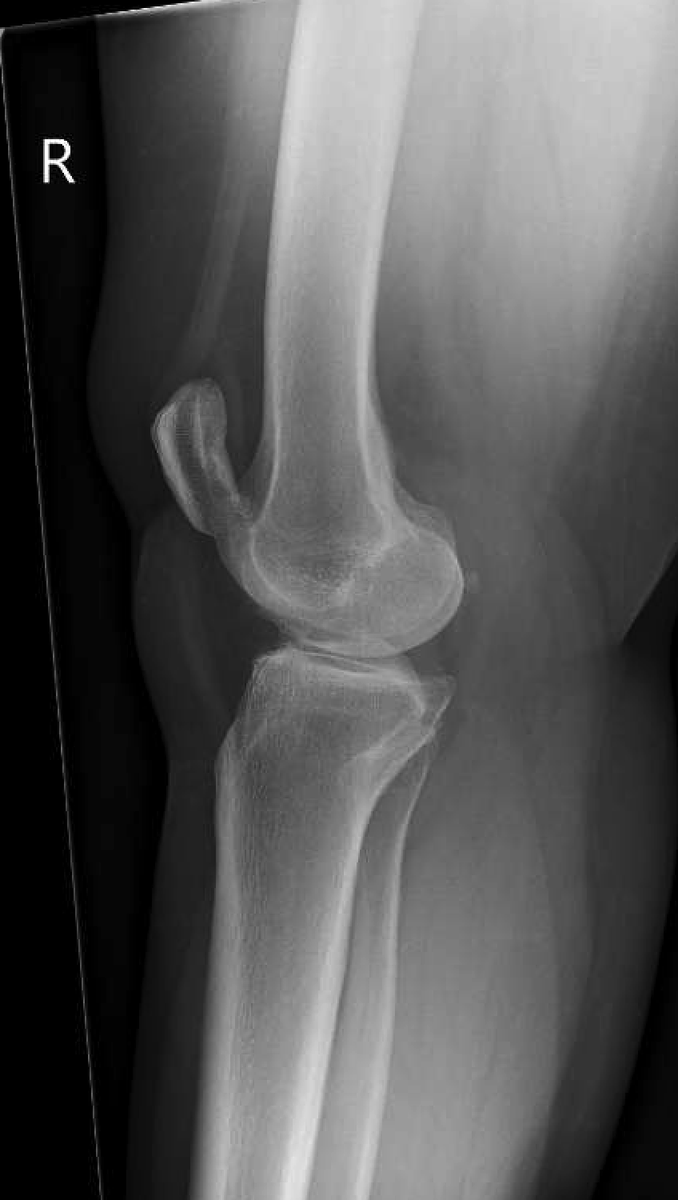 DanielLiechtiMD's tweet photo. Interesting case of the day. Patient with mild degenerative changes in their knee presents with a locked knee after reaching for something in a position of hyperextension. 

CT imaging performed in ED shows locked osteophytes on the inferior patella and trochlea. https://t.co/MeokfVgDmw