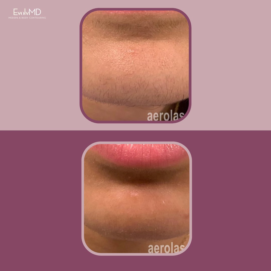 EvolvMD's tweet photo. This or That:  Razor vs. Laser?  We're team laser.  Milwaukee summers are way to short to shave. #laserhairremoval #milwaukee #milwaukeesummer #shaving https://t.co/h5444SyRXZ https://t.co/oBV3osSkvj