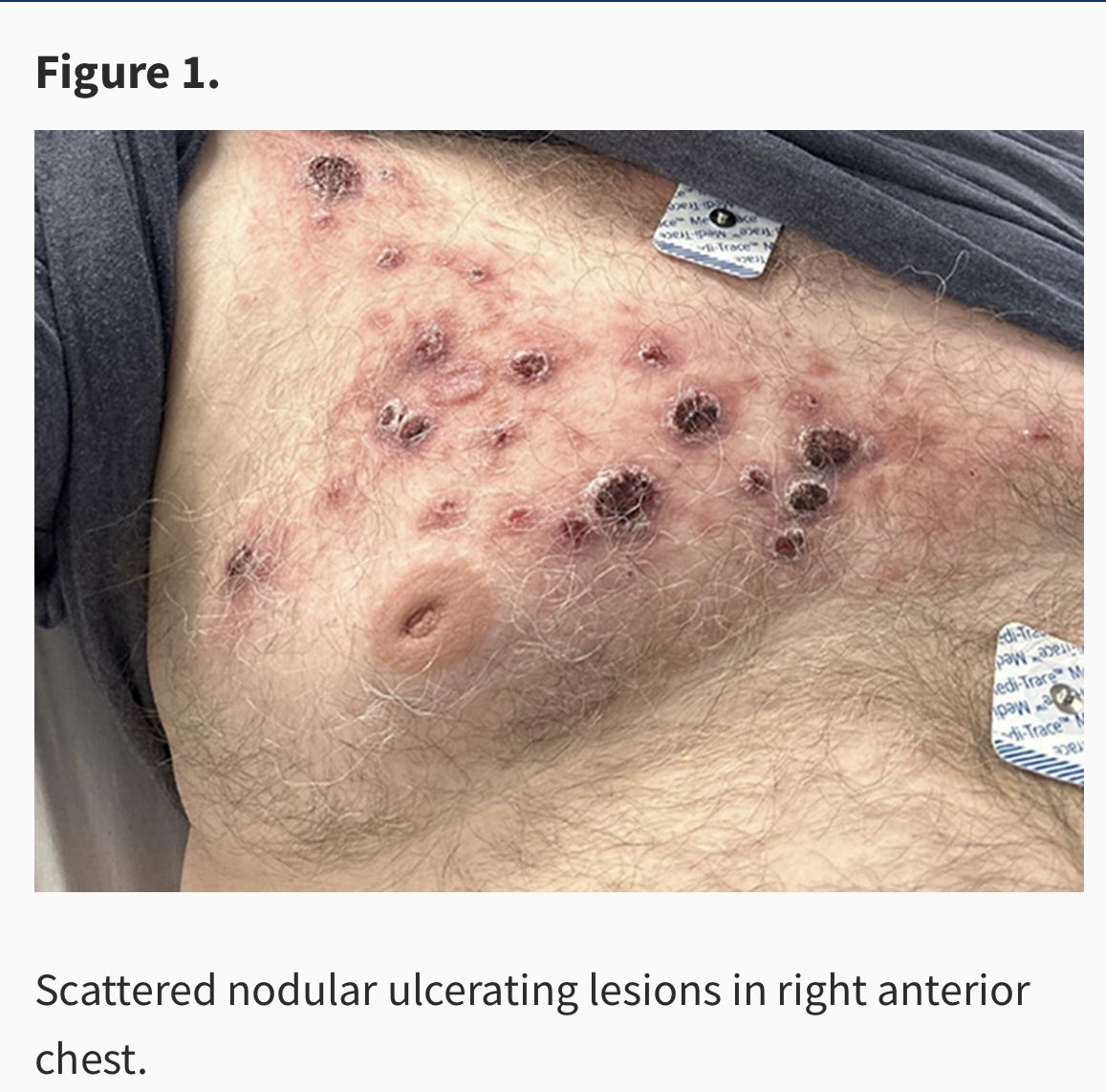 YurikoFukuta's tweet photo. My photo quiz has been published in Clinical Infectious Diseases 😊 https://t.co/bmTp9v2NUC #cid #MedEd https://t.co/uiMDQSTMDO