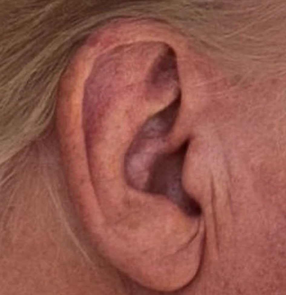Alec_Zeck's tweet image. Trump’s ear 2 weeks after the incident on July 13th.

Was Trump actually shot in the ear?