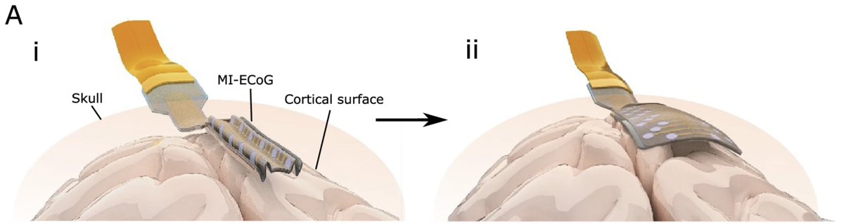 Damiano G. Barone (@baronedg) on Twitter photo Excited to announce our new publication in <a href="/NatureComms/">Nature Communications</a> on minimally invasive neural interfaces!
With surgery increasingly focused on reducing trauma and improving patient outcomes by making procedures smaller and safer, it's essential that technology advances in the same Excited to announce our new publication in <a href="/NatureComms/">Nature Communications</a> on minimally invasive neural interfaces!
With surgery increasingly focused on reducing trauma and improving patient outcomes by making procedures smaller and safer, it's essential that technology advances in the same