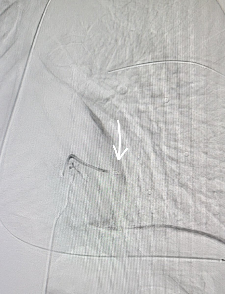 Temple Radiology (@templerads) on Twitter photo Patient stabbed in the back. CT shows hemothorax w/ active bleed. Intercostal angiogram shows contrast extravasation. Embolized with coils with cessation of bleed. Just another day. IR at its best with <a href="/DrECuthbertson/">Emily Cuthbertson</a> Dr. Leopold and Dr. Liss. <a href="/TempleRadRes/">Temple Radiology Residents</a> <a href="/SIR_ECS/">SIR ECS</a> <a href="/SIRRFS/">SIR RFS</a> #IRAD Patient stabbed in the back. CT shows hemothorax w/ active bleed. Intercostal angiogram shows contrast extravasation. Embolized with coils with cessation of bleed. Just another day. IR at its best with <a href="/DrECuthbertson/">Emily Cuthbertson</a> Dr. Leopold and Dr. Liss. <a href="/TempleRadRes/">Temple Radiology Residents</a> <a href="/SIR_ECS/">SIR ECS</a> <a href="/SIRRFS/">SIR RFS</a> #IRAD