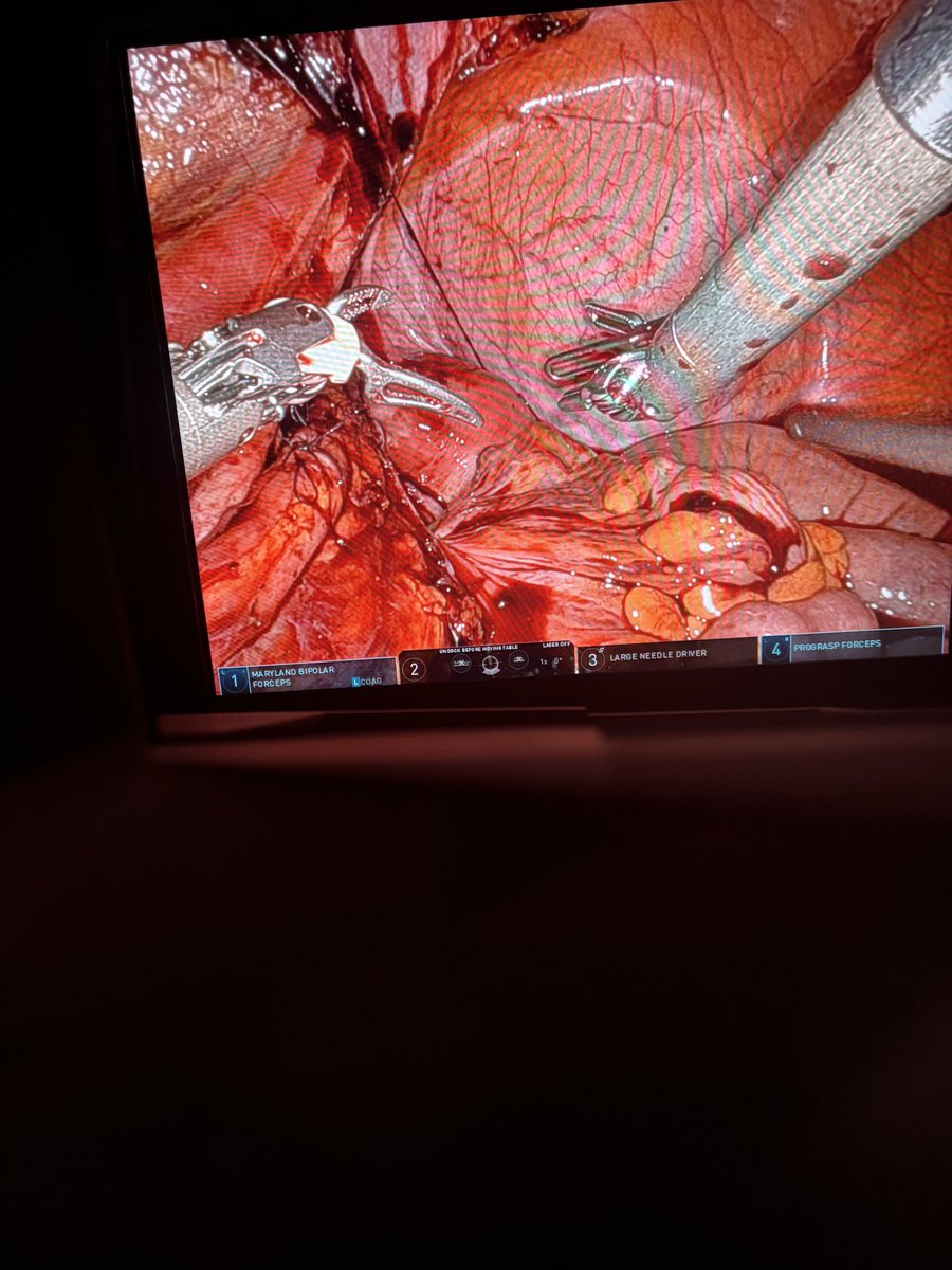 Greg Kyriazis (@greg_kyriazis) on Twitter photo Robotic endolithotomy is still an option for patients with failed endoscopic management of large ureteric stones. Patient had an uneventful procedure and got home stone free next day @DosMyht <a href="/MidYorkshireNHS/">Mid Yorkshire Teaching NHS Trust</a> <a href="/surgicalrobo/">Surgical Robotics Technology</a> Robotic endolithotomy is still an option for patients with failed endoscopic management of large ureteric stones. Patient had an uneventful procedure and got home stone free next day @DosMyht <a href="/MidYorkshireNHS/">Mid Yorkshire Teaching NHS Trust</a> <a href="/surgicalrobo/">Surgical Robotics Technology</a>