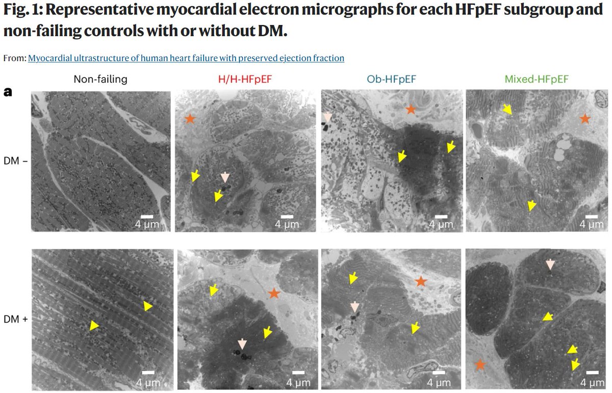 Research| Maddeb et al. show that while #HFpEF presents normal-looking contraction, the muscle looks abnormal, with disrupted contracting proteins, mitochondria and excess fat, particularly in the most obese patients.

👉rdcu.be/dPlJ7