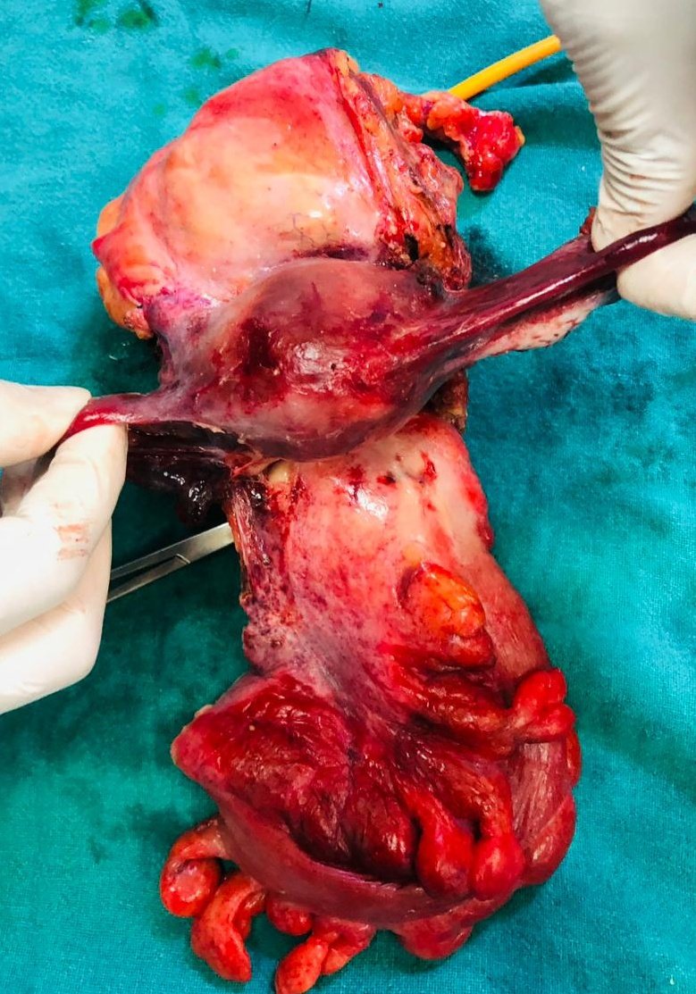 Deeplamichhane3's tweet photo. Total pelvic exenteration(TPE) should be offered for selective patients with pelvic cancers.
Our first patient with recurrent Ca Cx has NED at 5yrs post TPE. 
Another lady with pics below recovering well on 4th POD. 
https://t.co/xMyZsUdyZt
@ESSOnews @SocSurgOnc @TMCKolkata https://t.co/GtJd7PSxXj