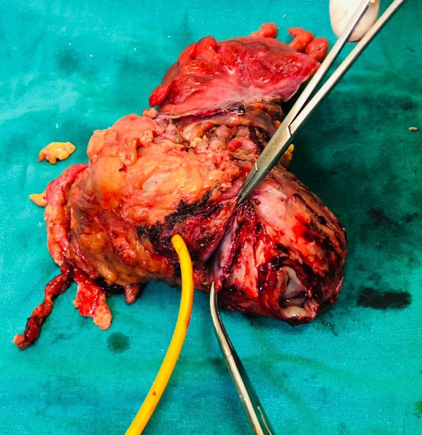 Deep lamichhane (@deeplamichhane3) on Twitter photo Total pelvic exenteration(TPE) should be offered for selective patients with pelvic cancers.
Our first patient with recurrent Ca Cx has NED at 5yrs post TPE. 
Another lady with pics below recovering well on 4th POD. 
doi.org/10.3126/njc.v5…
<a href="/ESSOnews/">European Society of Surgical Oncology (ESSO)</a> <a href="/SocSurgOnc/">Society of Surgical Oncology</a> <a href="/TMCKolkata/">Tata Medical Center</a> Total pelvic exenteration(TPE) should be offered for selective patients with pelvic cancers.
Our first patient with recurrent Ca Cx has NED at 5yrs post TPE. 
Another lady with pics below recovering well on 4th POD. 
doi.org/10.3126/njc.v5…
<a href="/ESSOnews/">European Society of Surgical Oncology (ESSO)</a> <a href="/SocSurgOnc/">Society of Surgical Oncology</a> <a href="/TMCKolkata/">Tata Medical Center</a>